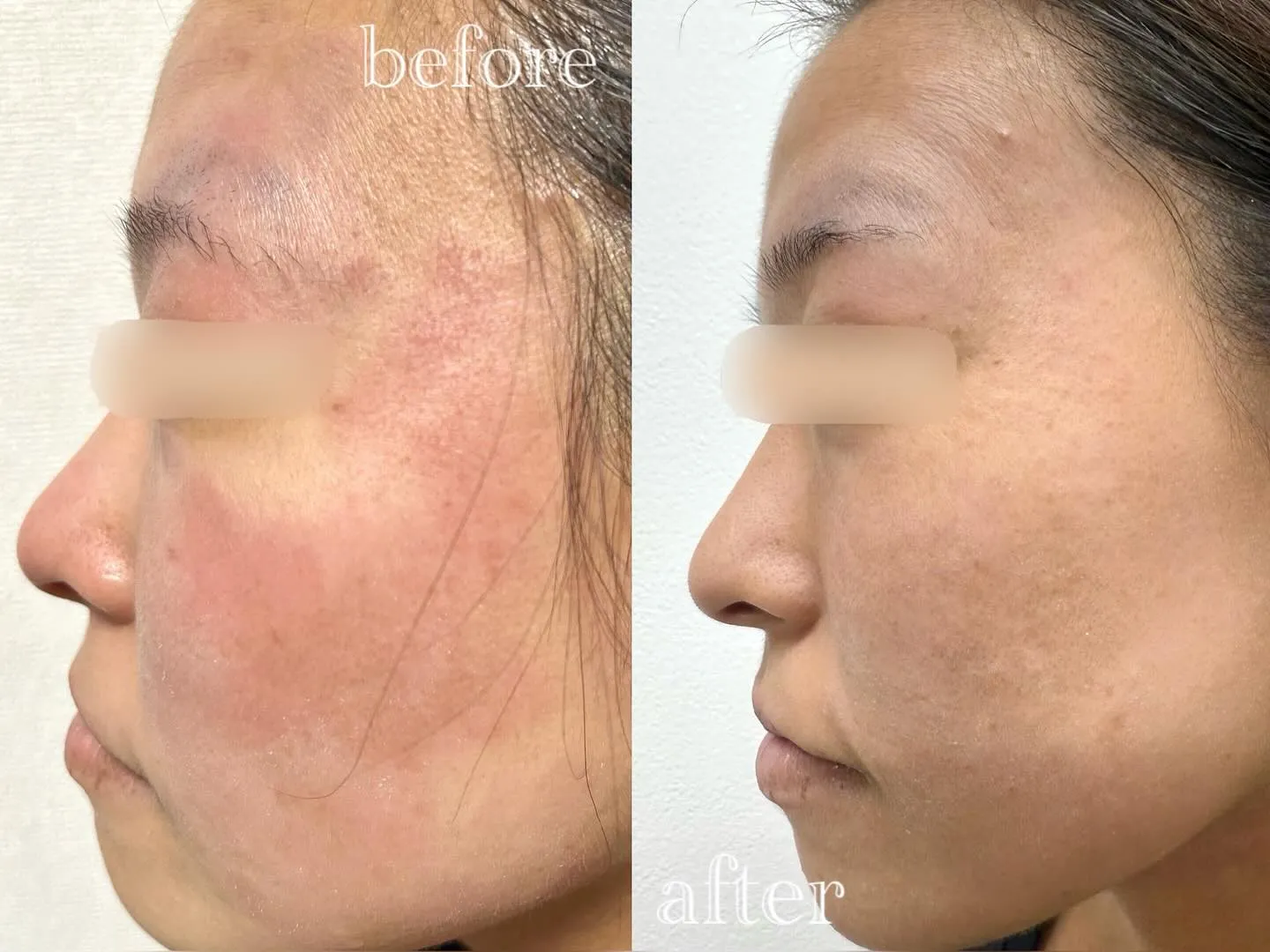 【 30代女性/アトピー・超敏感肌 】