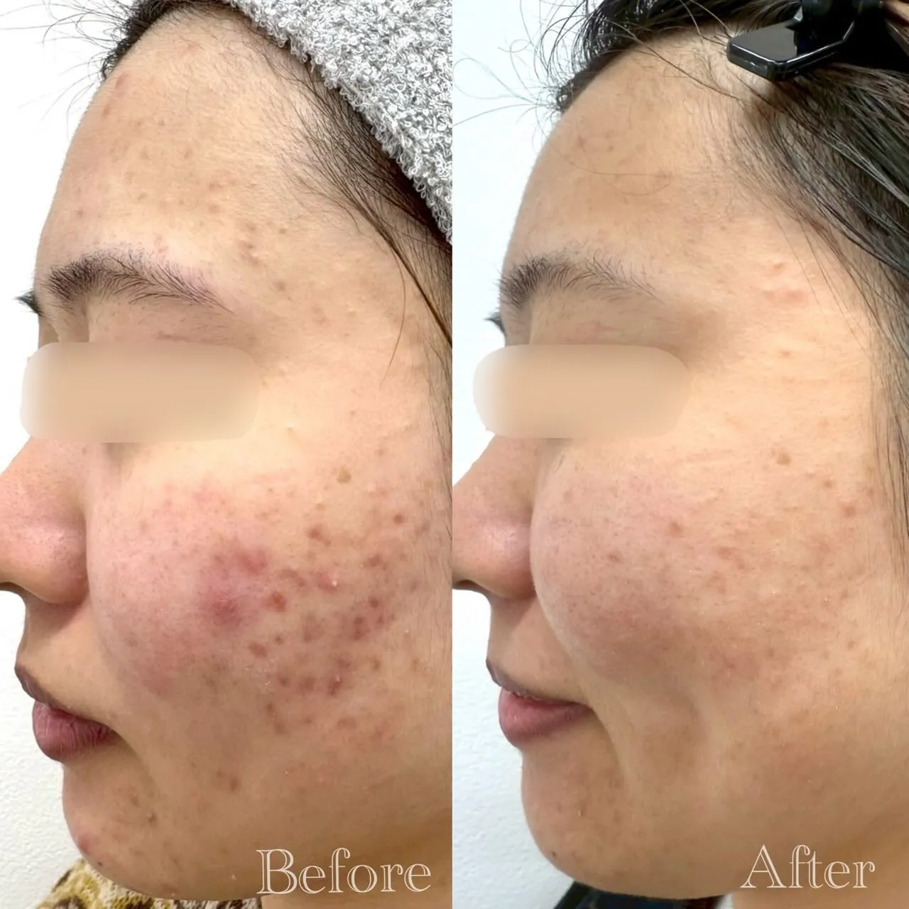 【 20代女性 / ニキビ、ニキビ跡、毛穴詰まり 】 