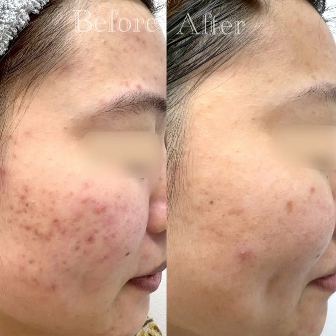 【 20代女性 / ニキビ、ニキビ跡、毛穴詰まり 】 