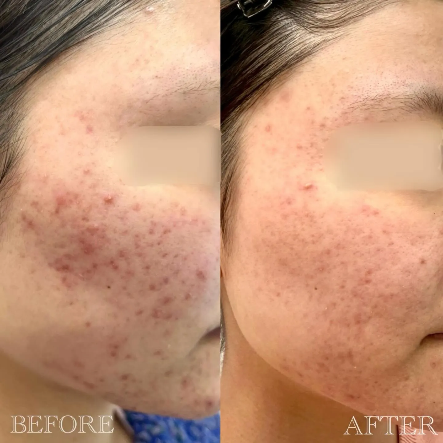 【 20代女性 / ニキビ、ニキビ跡、赤み 】