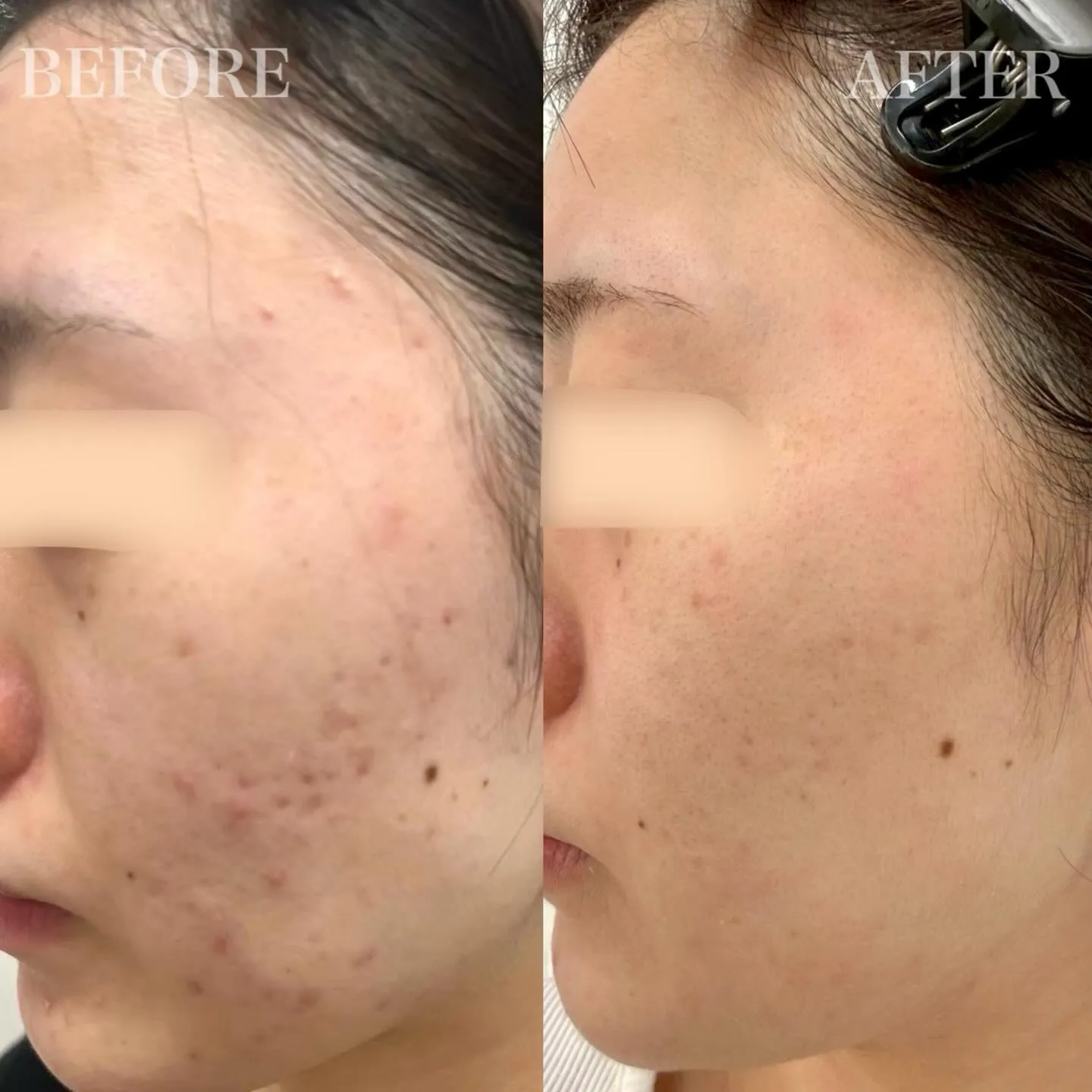 【 20代女性 / ニキビ・ニキビ跡 】