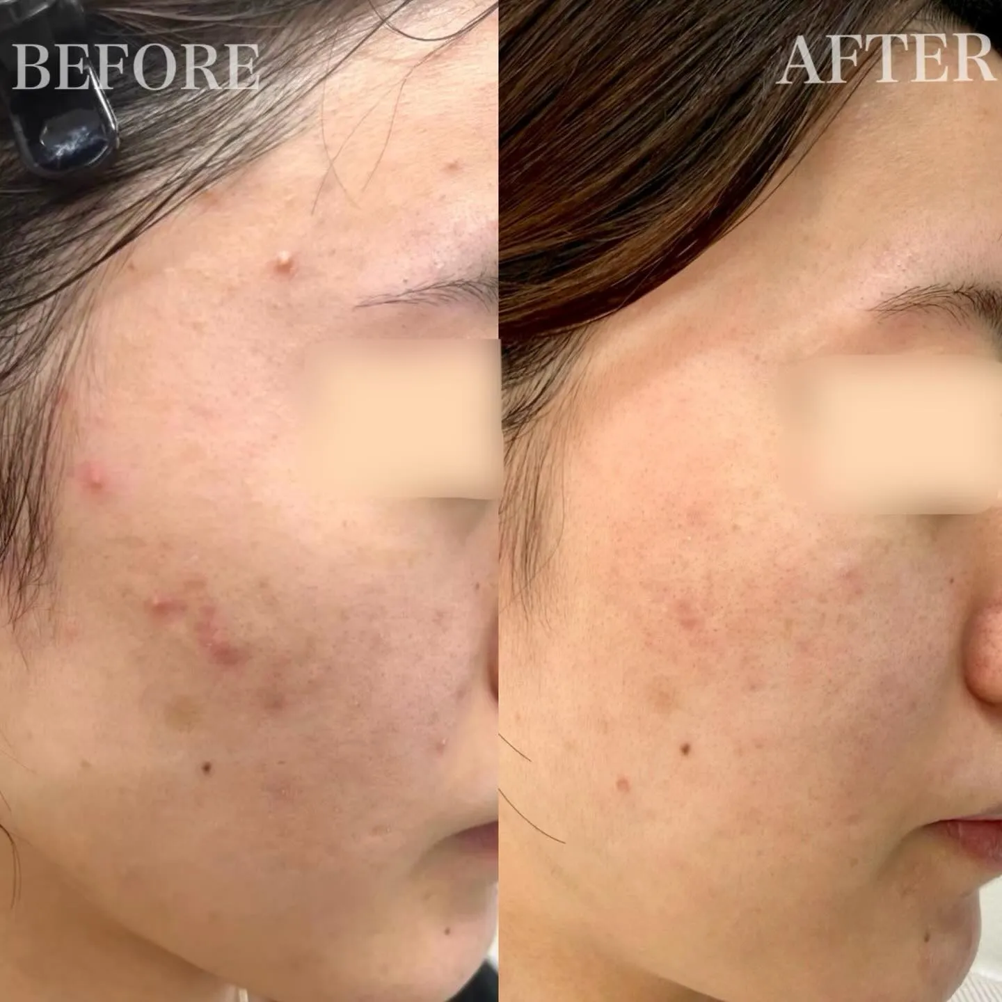 【 20代女性 / ニキビ・ニキビ跡 】