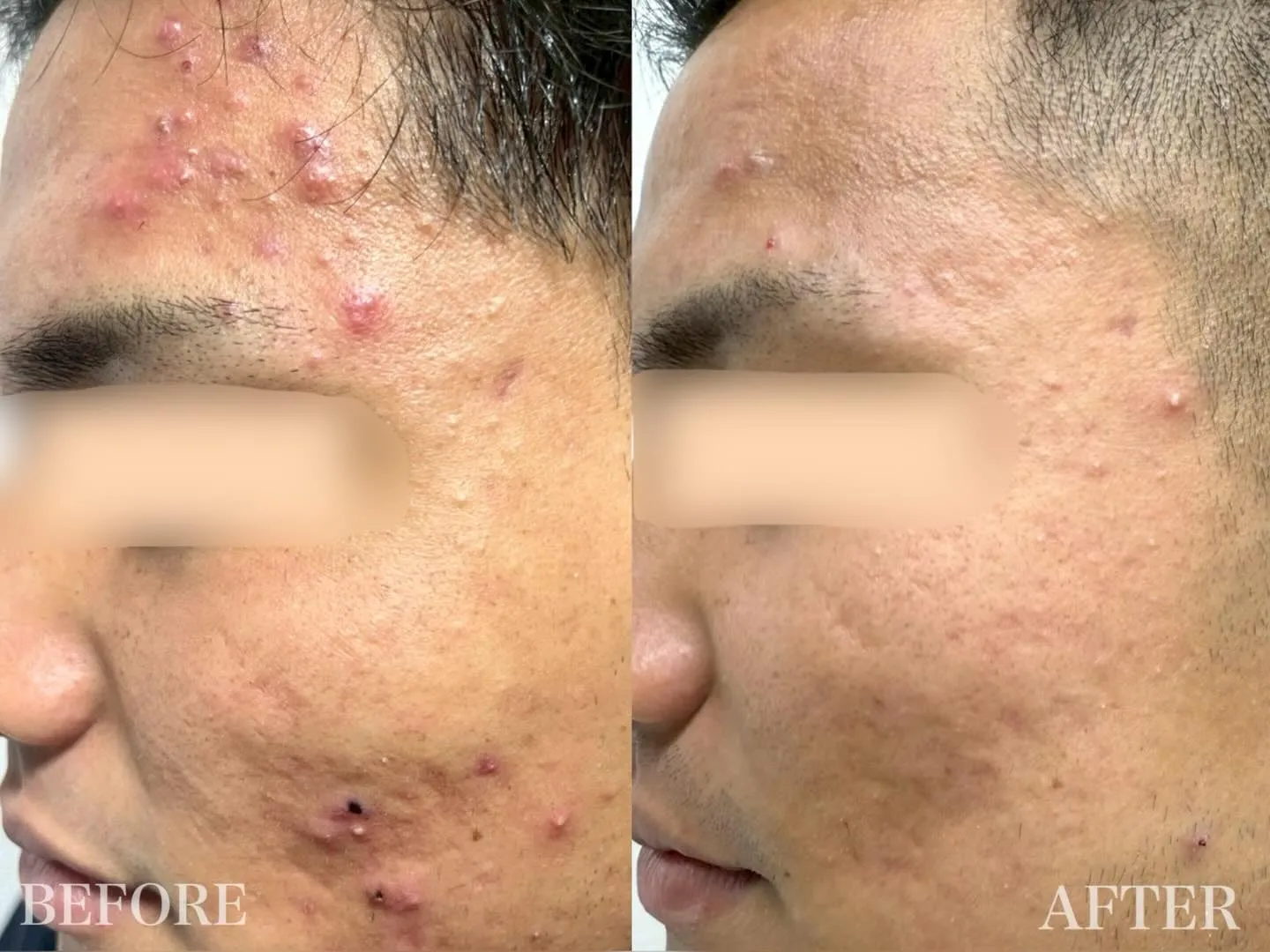 【 20代男性 / ニキビ、ニキビ跡 】