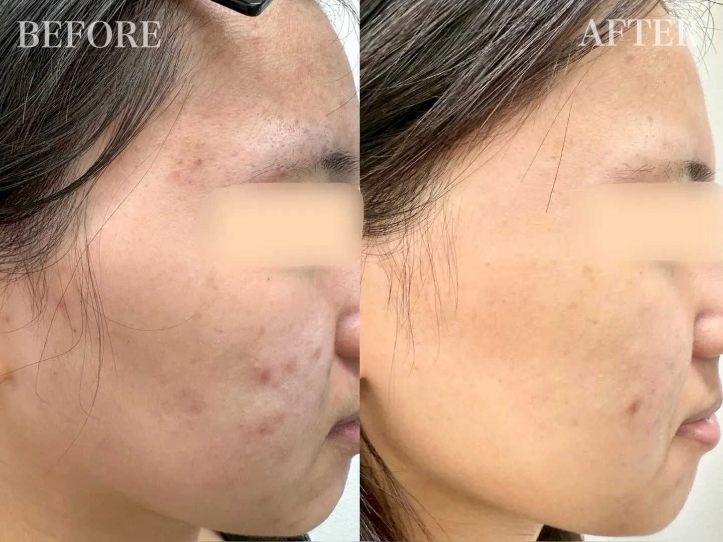 【 20代女性 / ニキビ、ニキビ跡 】