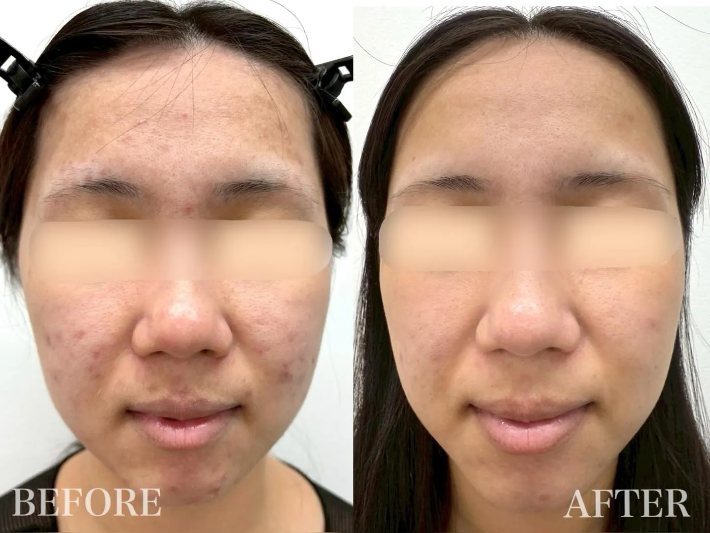 【 20代女性 / ニキビ、ニキビ跡 】